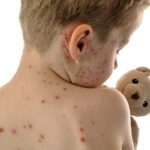 Measles In Mumbai : ప్రాణాంతకంగా మారిన మీజిల్స్.. చిన్నారులకు డేంజర్..