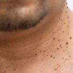 Pimples : 3 రోజుల్లో పులిపిర్లు రాలిపోయే చిట్కాలు