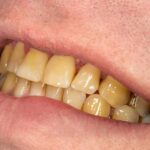 Teeth Grinding in Sleep: నిద్రలో మీకు పళ్లు కొరికే అలవాటు ఉందా?