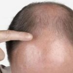 Bald Head Treatment : బట్టతల ఉందా.. అయితే చలో ఇస్తాంబుల్..!