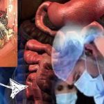 Fly in Man Intestines : వృద్ధుడి పేగుల్లో ఈగ.. షాక్ అయిన డాక్టర్లు