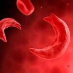sickle cell : సికిల్ సెల్‌కు జీన్ థెరపీ