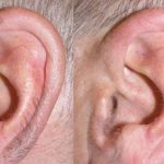Hairy Ears : చెవిపై వెంట్రుకలు.. ఏం జరుగుతుందో తెలుసా..!