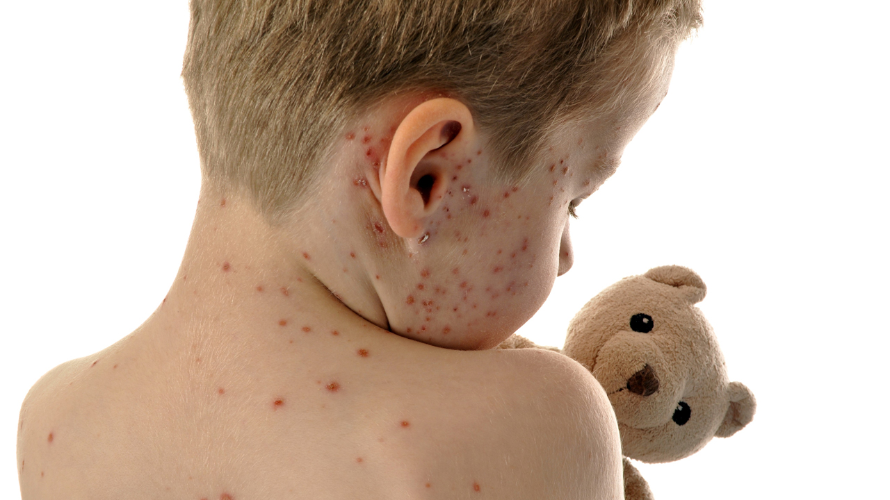 Measles Spreads In MP