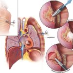 Caner Drug : మొండి కేన్సర్‌కు దివ్యౌషధం..