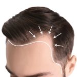 Receding Hairline : జుట్టు ఊడటం మొదలైందా?.. ఈ మిస్టేక్స్ చేయకండి!