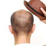 Hat Cause Hair Loss : క్యాప్ పెట్టుకుంటే జుట్టు రాలుతుందా..?