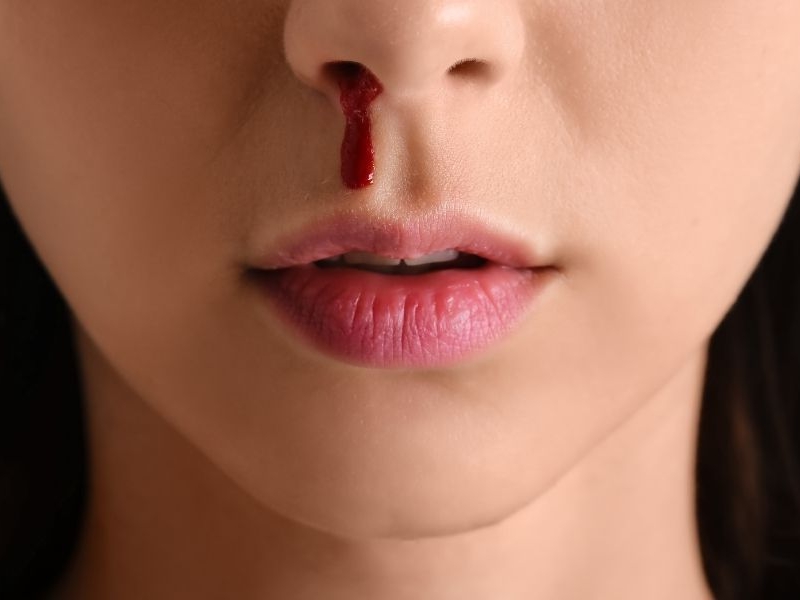 Nose Bleeding : ముక్కు నుంచి రక్తస్రావం జరిగితే ఏమోతుందో తెలుసా..?