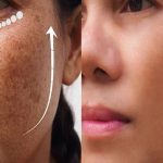 How To Remove Pigmentation on Face: మంగు మచ్చలతో ఇబ్బంది పడుతున్నారా.. అయితే ఇలా చేయండి