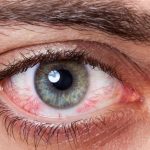 Eye Cancer Symptoms : కళ్లు ఎర్రగా ఉన్నాయా? అయితే క్యాన్సర్ కావచ్చు!