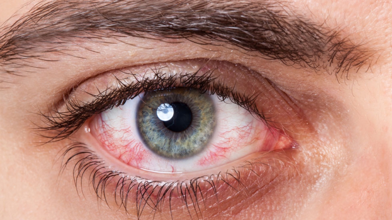 Eye Cancer Symptoms : కళ్లు ఎర్రగా ఉన్నాయా? అయితే క్యాన్సర్ కావచ్చు!