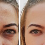 Dark Circles: కళ్ల కింద డార్క్ సర్కిల్స్ కి  బై బై చెప్పండిలా !
