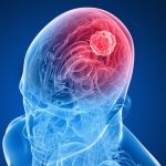 Brain Cancer Symptoms: మీలో ఈ లక్షణాలు ఉన్నాయా.. అయితే జాగ్రత్త.. మెదడు క్యాన్సర్ వచ్చే ప్రమాదం