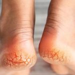 Cracked Heels: పాదాల పగుళ్లతో ఇబ్బంది పడుతున్నారా.. ఇవి వాడితే మీ సమస్య మాయం..