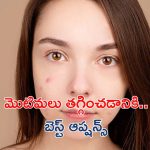 Pimples Removal Tips:మొటిమలు తగ్గడానికి ఇవే బెస్ట్ ఆప్షన్స్ !