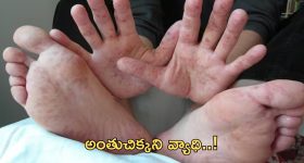 Hand Foot Mouth: రాష్ట్రంలో ‘హ్యాండ్ ఫుట్ మౌత్’ కలకలం.. వ్యాధి లక్షణాలు ఇవే!