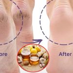 Cracked Heels: ఇలా చేస్తే.. కాళ్ల పగుళ్లు త్వరగా తగ్గిపోతాయ్