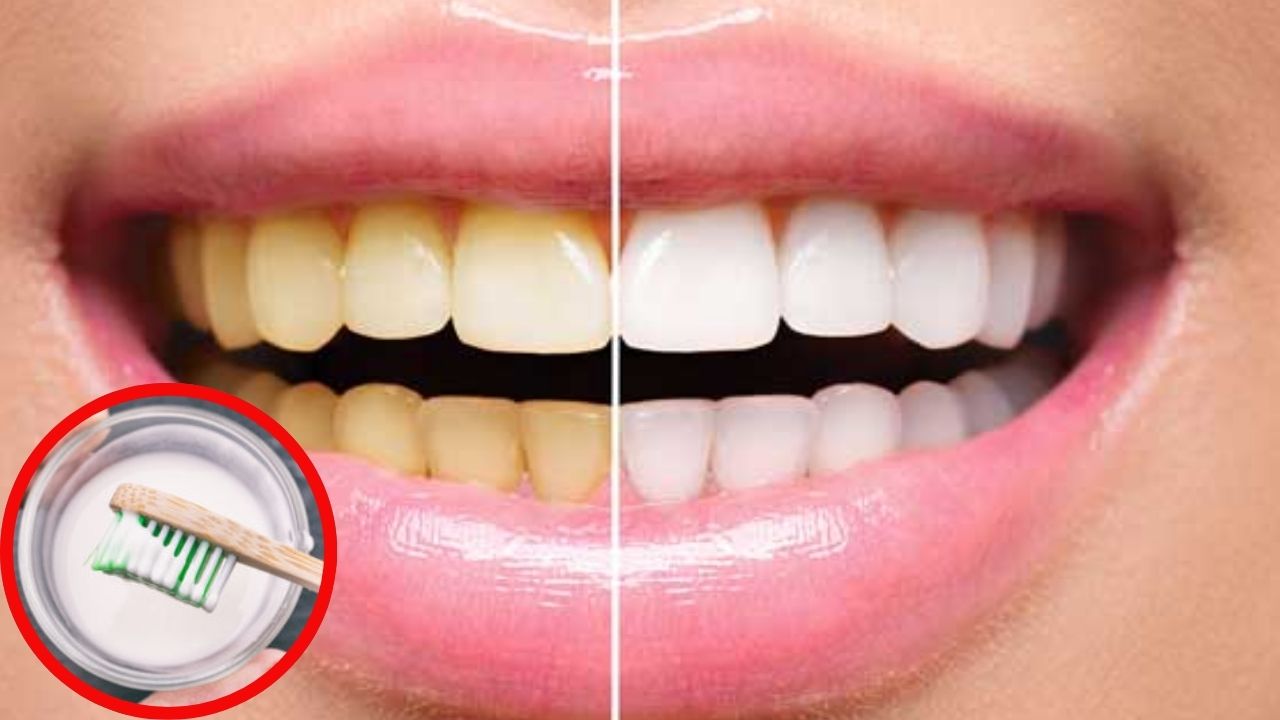 Teeth Whitening Tips: ఇలా చేస్తే.. గార పట్టిన పళ్లు క్షణాల్లోనే.. తెల్లగా మెరిసిపోతాయ్