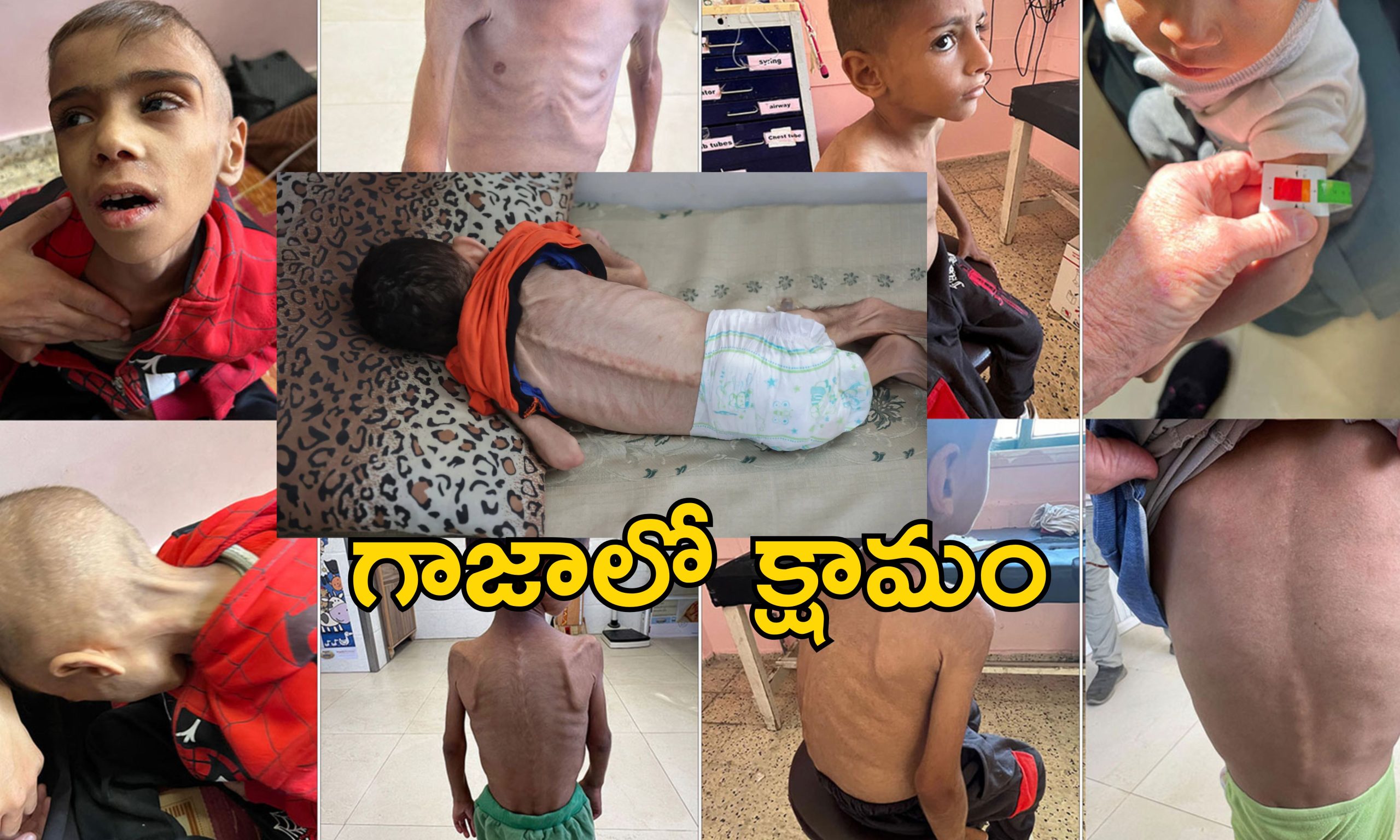 Gaza Famine : గాజాలో ఆకలికేకలు.. క్షామంతో మృత్యుఘోష.. కళేబరాల్లా పిల్లల శరీరాలు