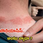 Psoriasis: సోరియాసిస్ ఎందుకు వస్తుంది ? ఇది అంటు వ్యాధా ?