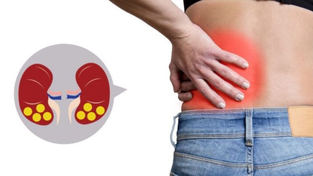 Kidney Stones: కిడ్నీలో రాళ్లు ఏర్పడకుండా ఉండాలంటే.. ఏం చేయాలి ?