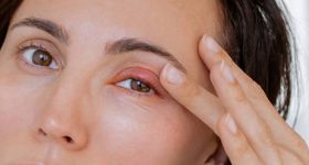 Stye: కంటి కురుపు ఎందుకు వస్తుంది? ఇంట్లోనే దీన్ని తగ్గించడం సాధ్యమేనా?