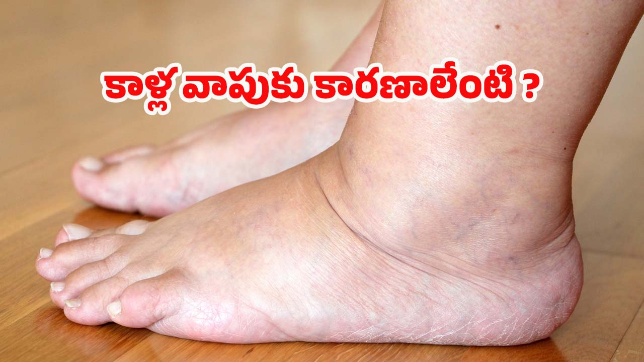 Leg Swelling: కాళ్ల వాపుకు కారణాలు ఏంటి ?  ఎలా తగ్గించుకోవాలో తెలుసా ?