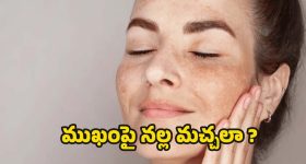 Dark Spots On Face: ముఖంపై నల్ల మచ్చలా ? ఇలా చేస్తే.. సమస్య దూరం