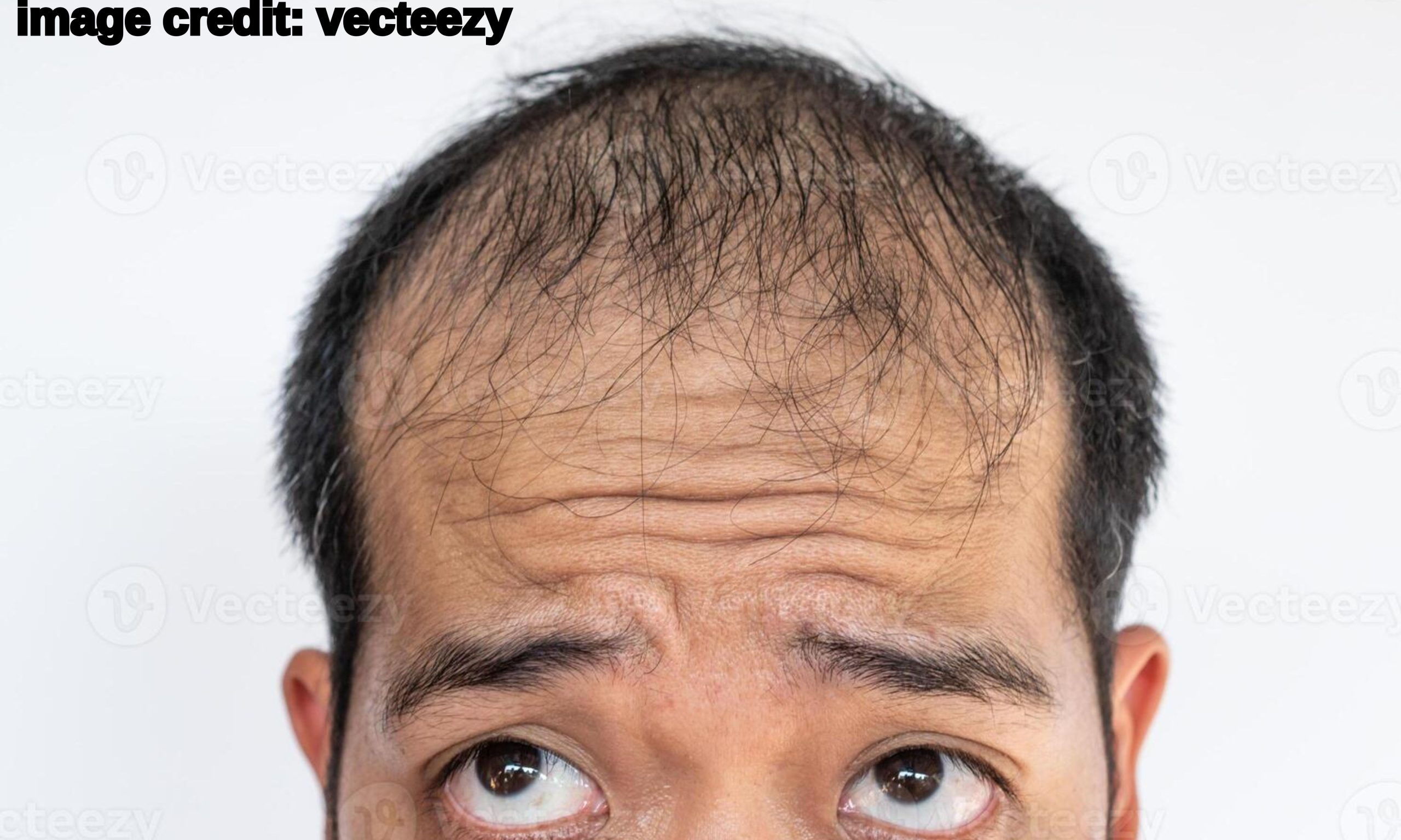 Hair Loss Natural Solution: మీ జుట్టు రాలిపోయిందా?.. చింతించకండి.. బలమైన జుట్టు తిరిగిరావాలంటే ఇలా చేయండి