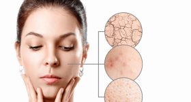 Dry Skin Tips: డ్రై స్కిన్ సమస్యా ? సమ్మర్‌లో ఈ టిప్స్ ఫాలో అవ్వండి !
