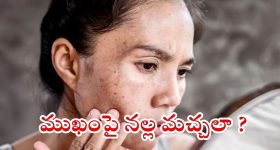 Dark Spots: ముఖంపై నల్ల మచ్చలా ? ఇలా చేస్తే.. ప్రాబ్లమ్ సాల్వ్