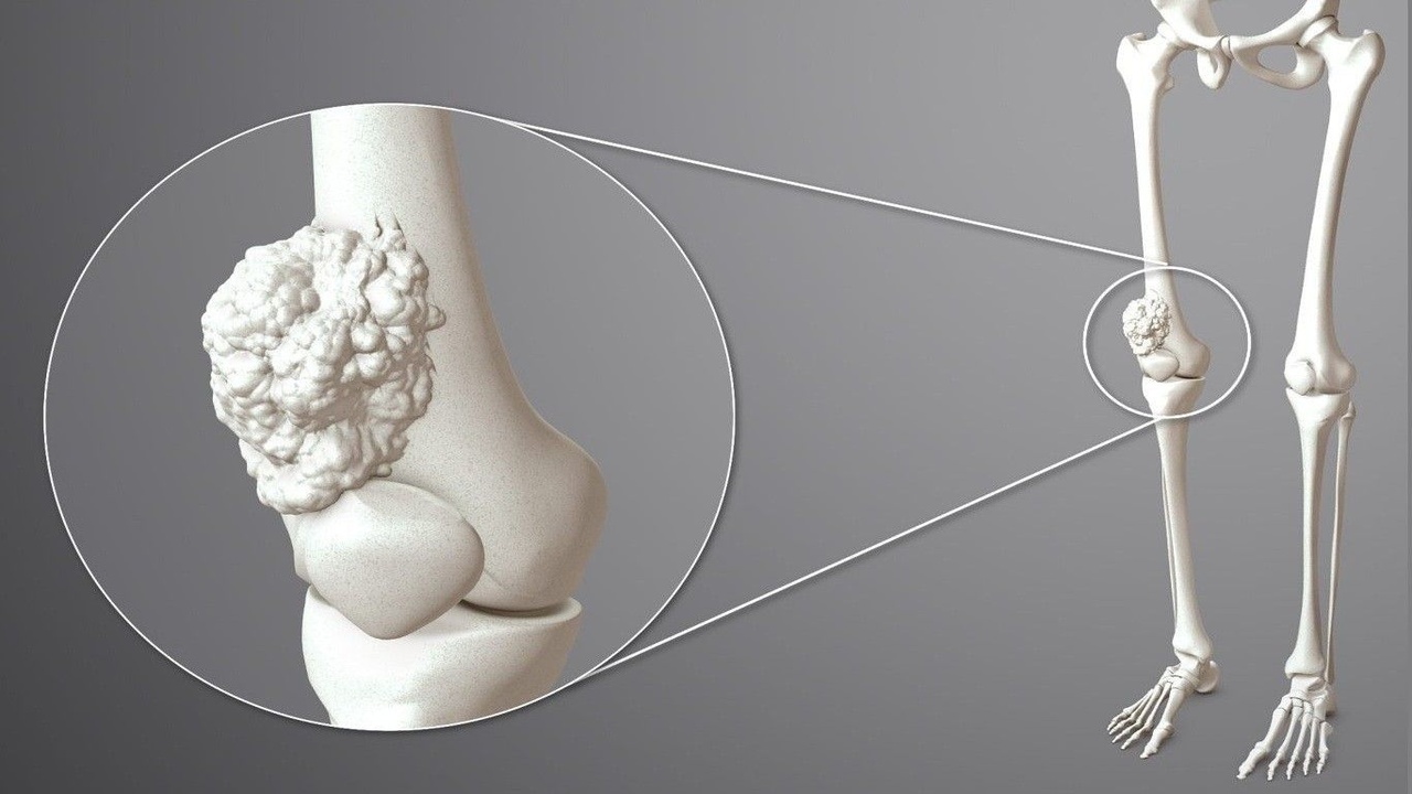Bone Cancer: ఇవన్నీ ఎముక క్యాన్సర్ లక్షణాలే.. కానీ 95 శాతం మంది వీటిని పట్టించుకోరు