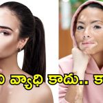 Vitiligo Day 2025: బొల్లి అంటే ఏంటి?.. ఈ చర్మ వ్యాధికి కారణాలు, అపోహలు