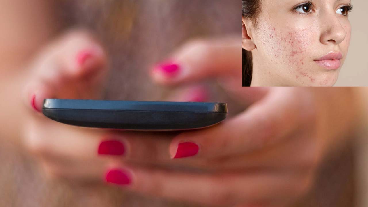 Skin Problems: మొబైల్ ఫోన్లతో చర్మ సమస్యలు.. పరిశోధనల్లో షాకింగ్ నిజాలు