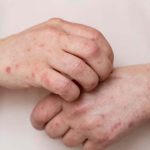 Causes Of Skin Allergy: స్కిన్ అలెర్జీకి కారణాలేంటో తెలుసా ?
