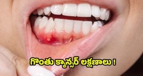 Oral Cancer: గొంతు క్యాన్సర్ లక్షణాలు ఎలా ఉంటాయి ?