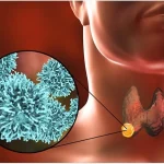 Thyroid Cancer: మీలో ఈ లక్షణాలు ఉన్నాయా ? థైరాయిడ్ క్యాన్సర్ కావొచ్చు !