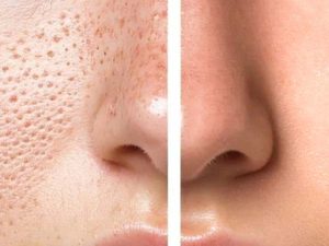 Open Pores On Face: ఓపెన్ పోర్స్ సమస్యతో ఇబ్బంది పడుతున్నారా ?