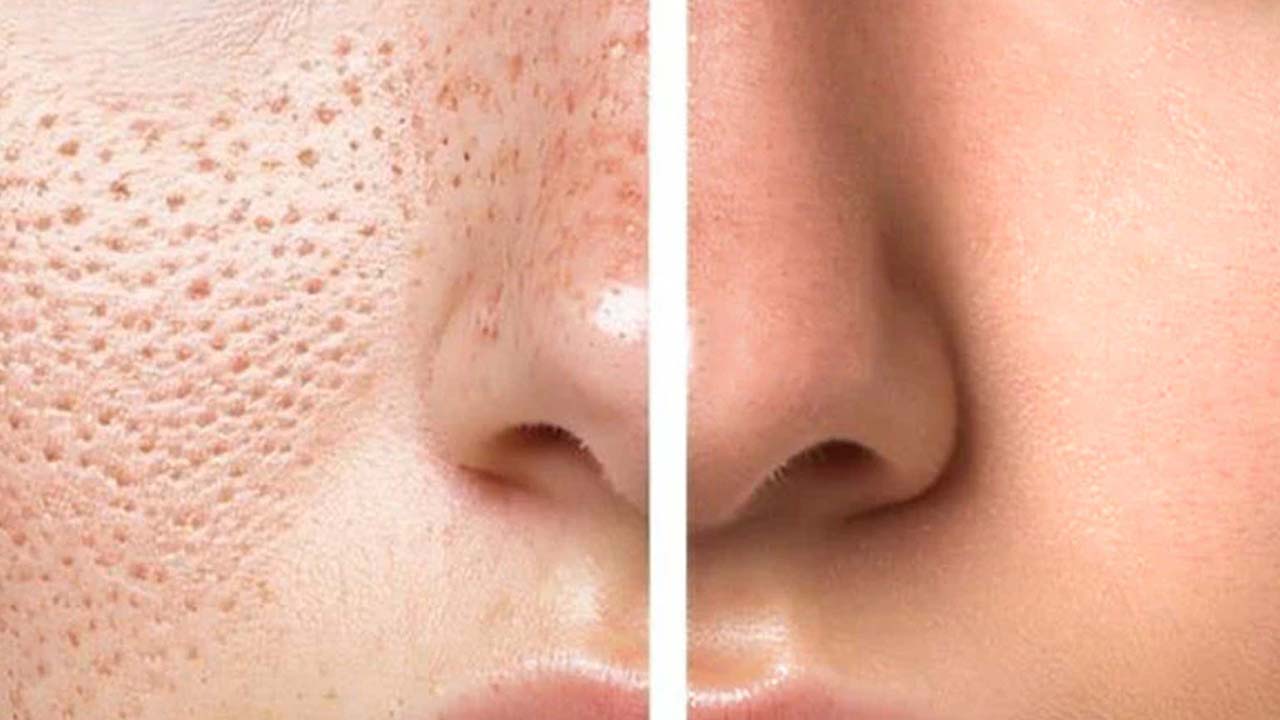 Open Pores On Face: ఓపెన్ పోర్స్ సమస్యతో ఇబ్బంది పడుతున్నారా ?