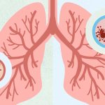 Pneumonia causes: న్యుమోనియా రావడానికి అసలు కారణాలివే !