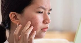 Pimples: ఈ ఒక్క ఫేస్ ప్యాక్ వాడితే.. ముఖంపై మొటిమలు మాయం !