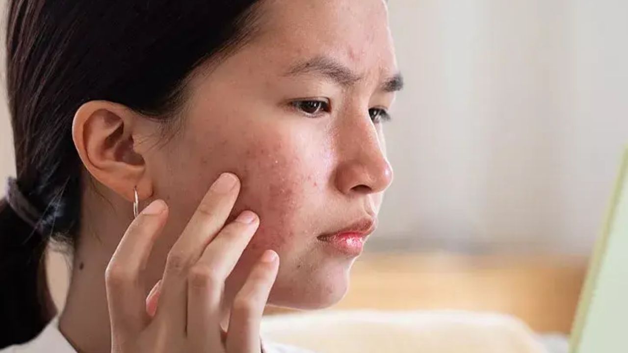 Pimples: ఈ ఒక్క ఫేస్ ప్యాక్ వాడితే.. ముఖంపై మొటిమలు మాయం !