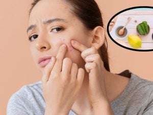 Get Rid of Pimples: మొటిమలు త్వరగా తగ్గాలంటే ?